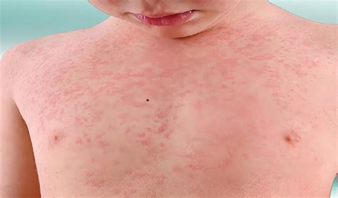 fotos de alergia a amoxicilina-4